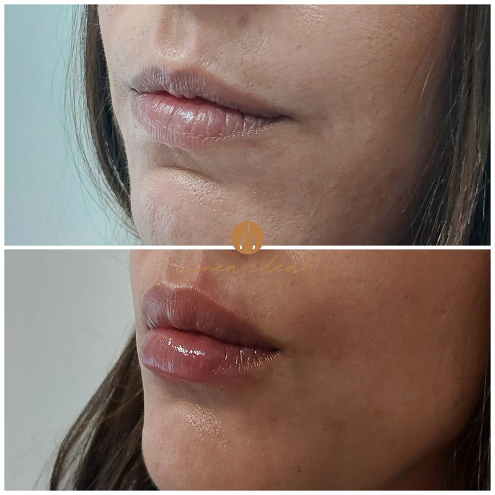 Before and After Result